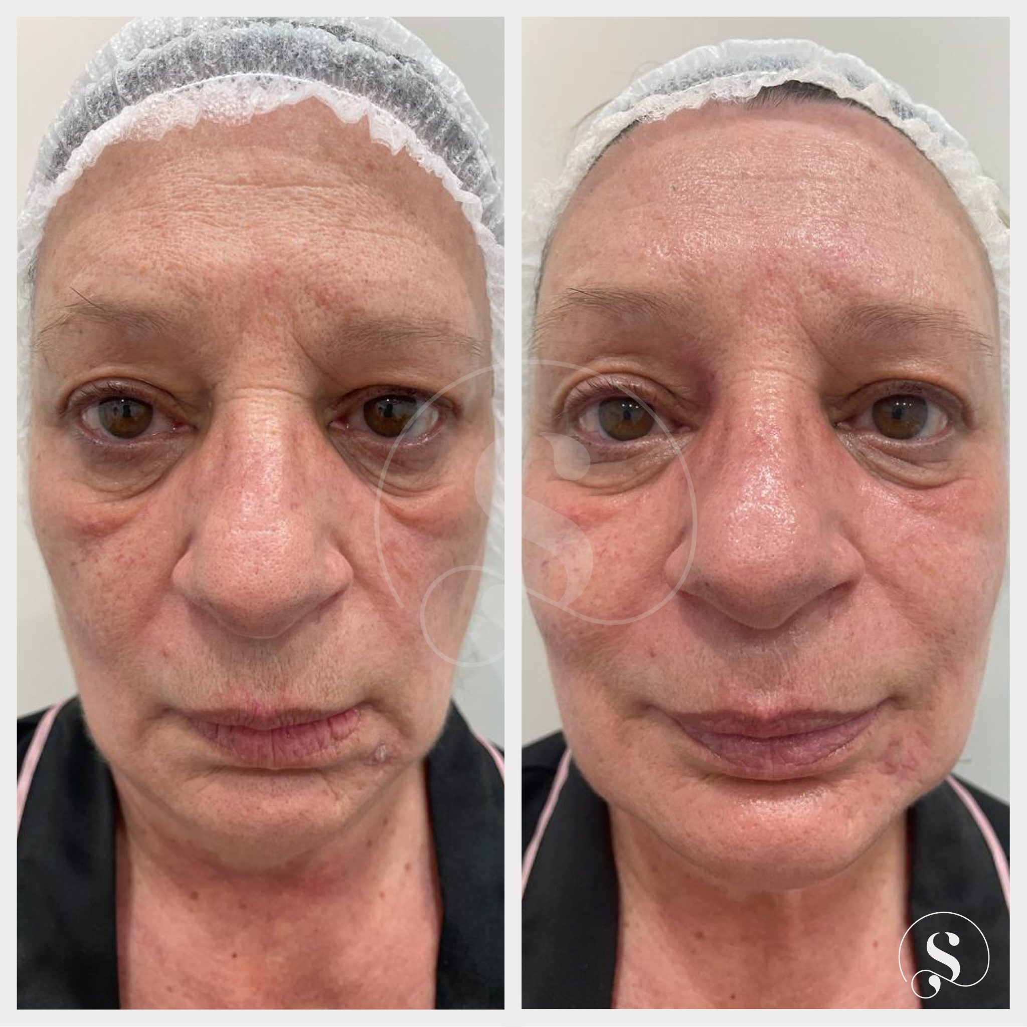 foto en carrusel 2n posición antiaging