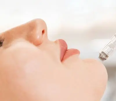 microneedling Barcelona